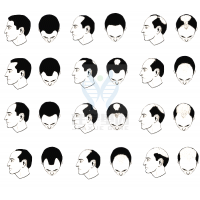 【佳學(xué)基因檢測】過早<font color='red'>脫發(fā)</font>、掉發(fā)太多怎么辦？你的方法可能是錯(cuò)的！
